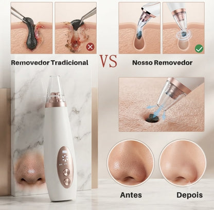 Removedor De Cravos E Espinhas Cleaning USB Recarregável Portátil