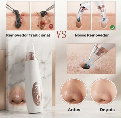 Removedor De Cravos E Espinhas Cleaning USB Recarregável Portátil